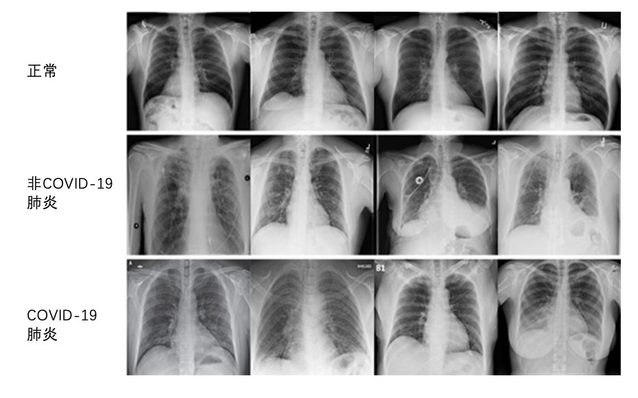 新冠肺炎肺部x光片图片