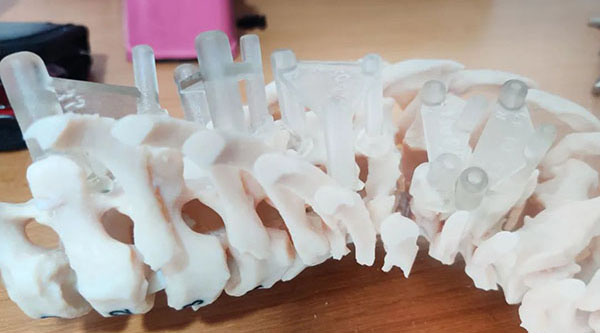 3D打印为脊柱侧凸治疗提供支持